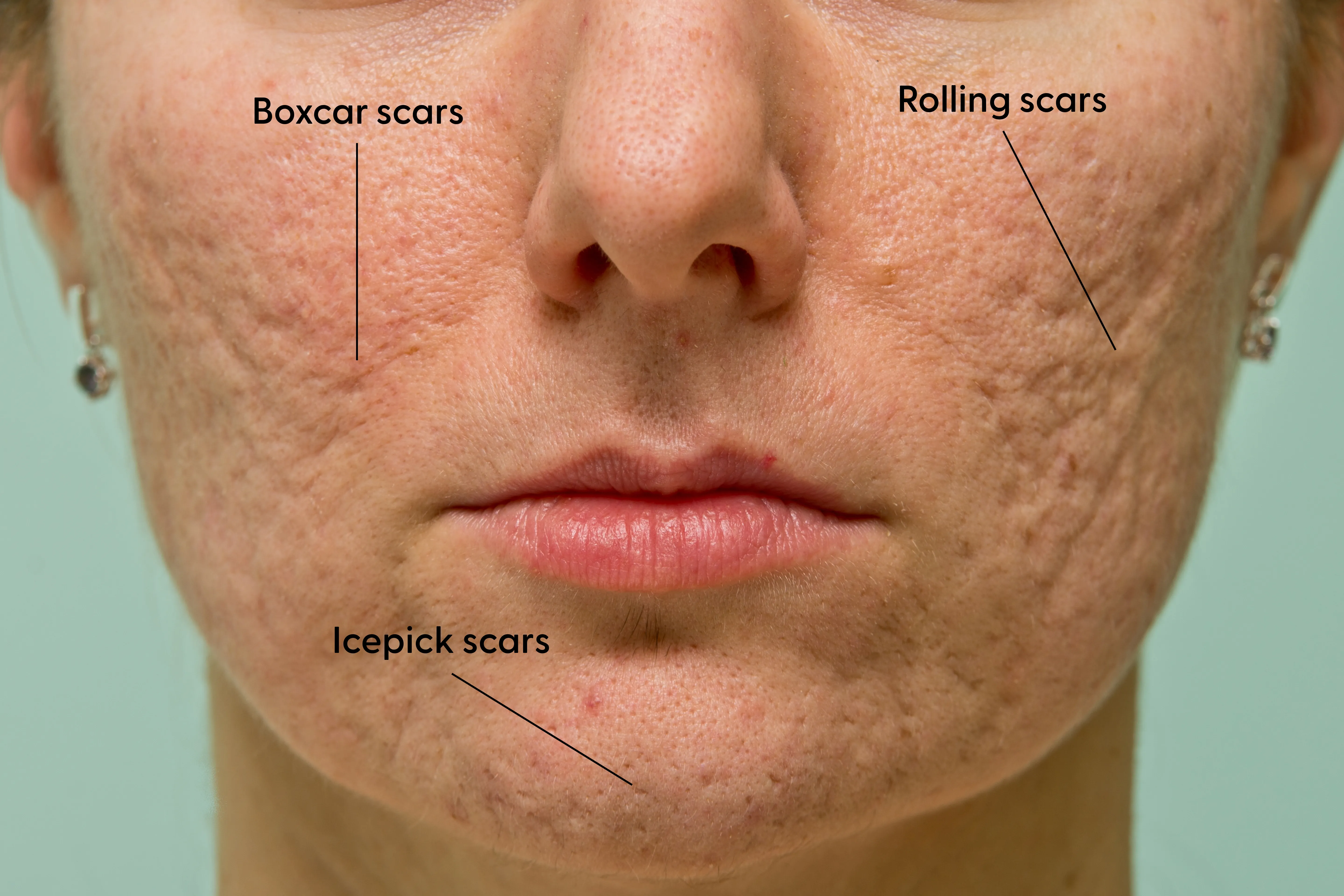 Different types of atrophic scars