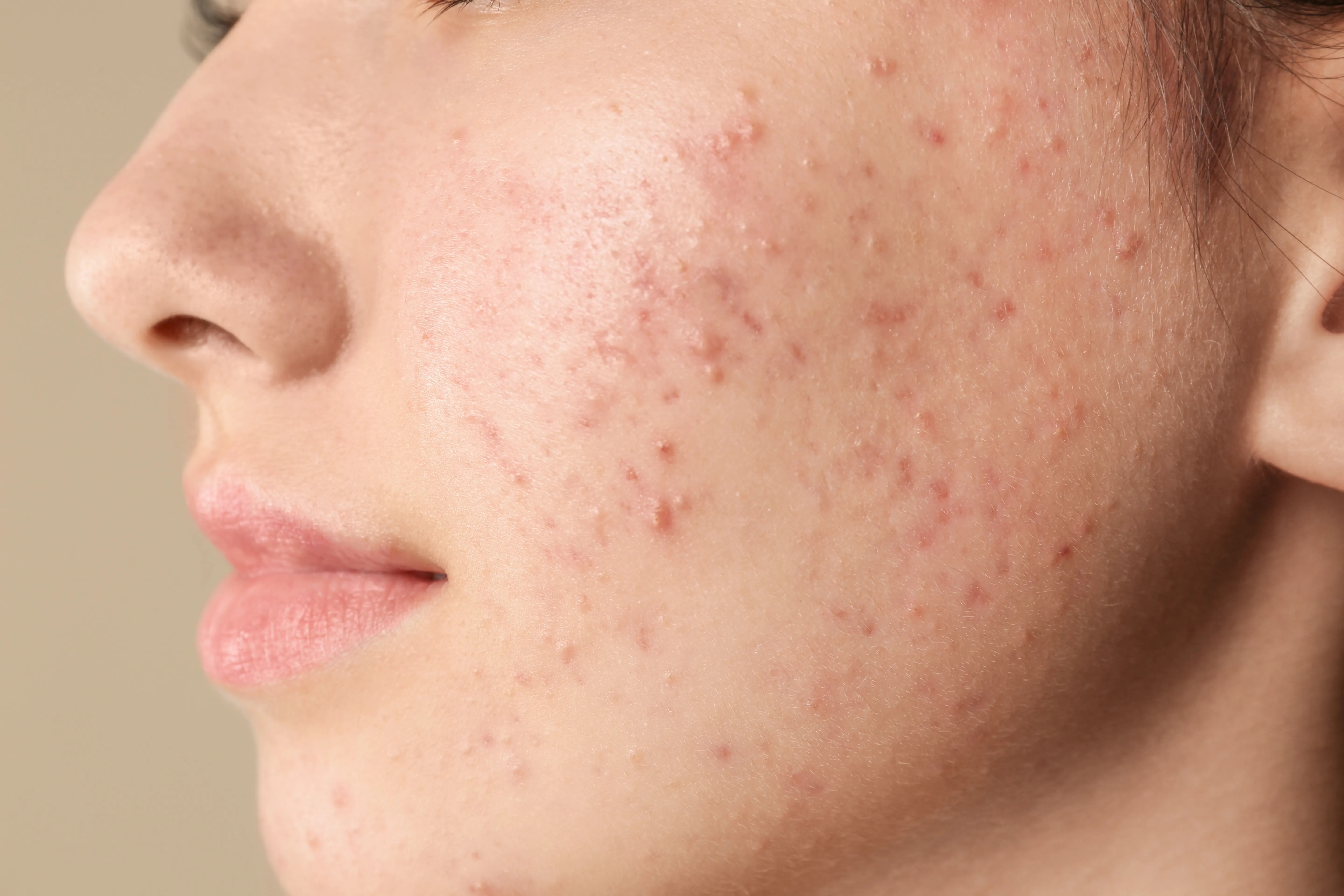 Face with acne