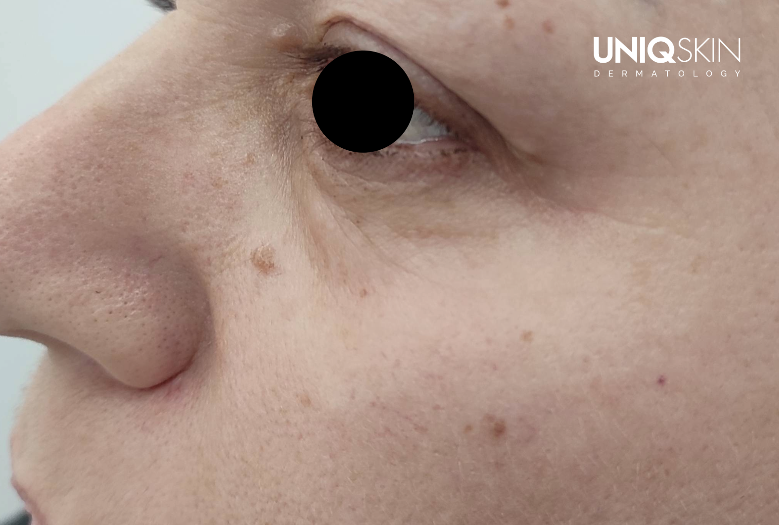 Μετά τη θεραπεία - αφαίρεση χοριακού σπίλου και μεσοθεραπεία